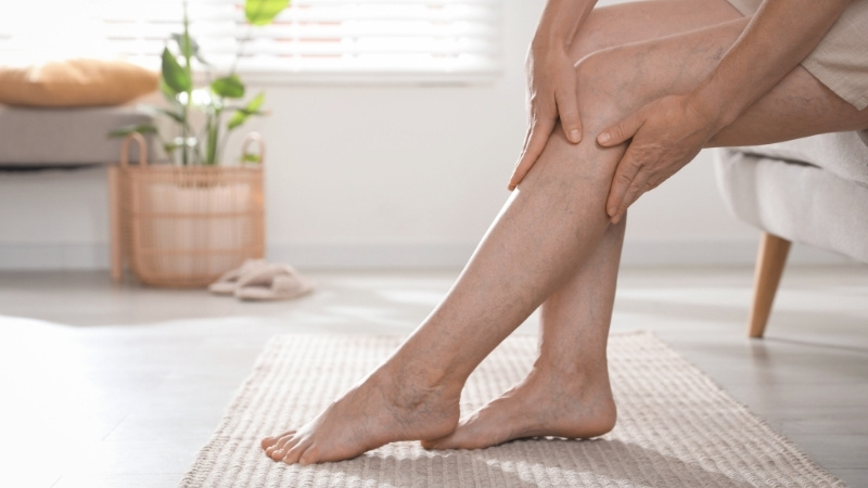 Giãn tĩnh mạch chân khiến bạn nhức mỏi bắp chân về đêm